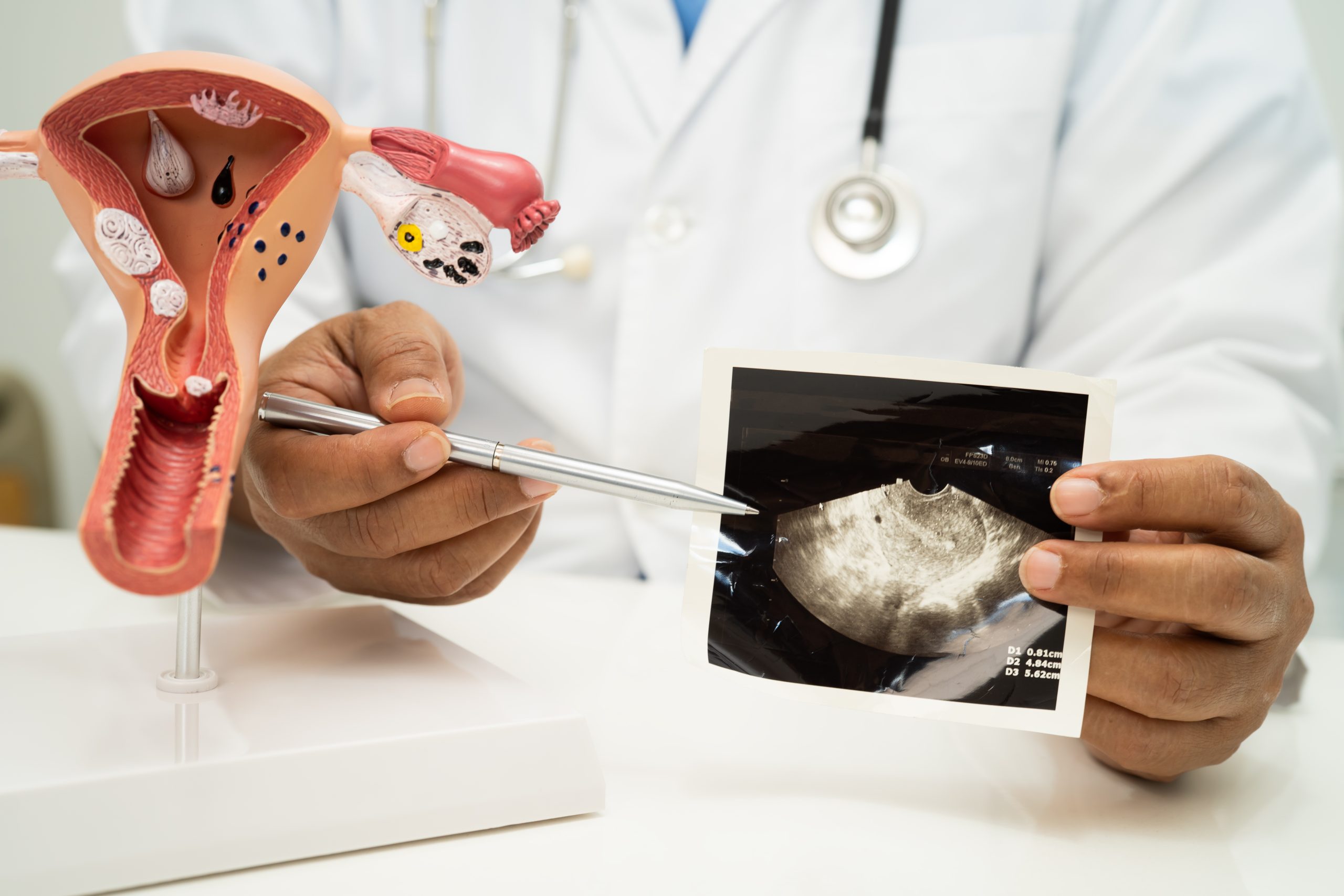 أسباب وعلاج لحمية عنق الرحم للدكتور وحيد عبد العال